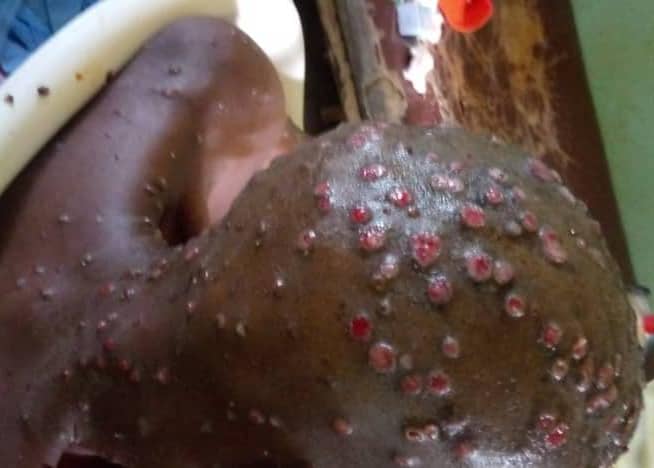 Santé | Monkeypox au Sud-Kivu : 825 cas et 8 décès, une mobilisation urgente requise