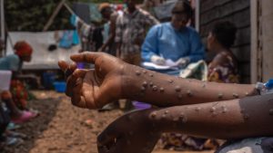 MPOX en RDC